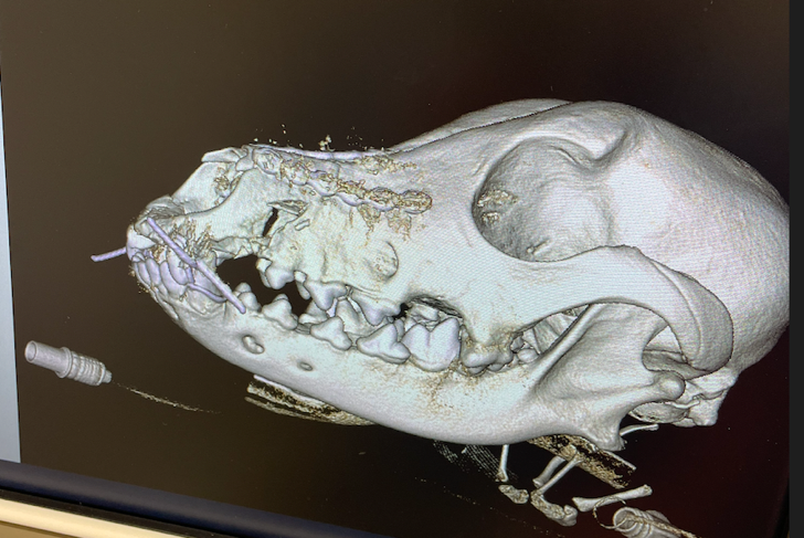 Post-op of a maxillary fracture. Titanium Plate fixation